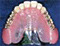 チタン義歯（プレミアムコンフォート